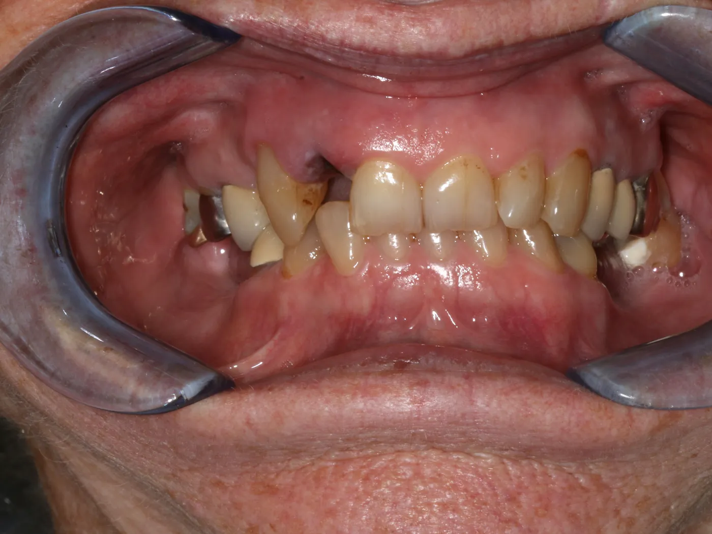 Before: clinical photo with a cheek retractor showing missing and damaged upper front teeth